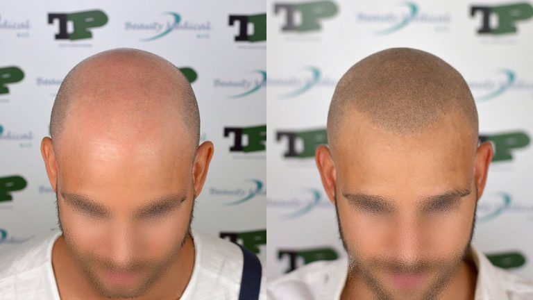 Alopecia: la tricopigmentazione è una delle soluzioni estetiche